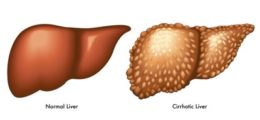 Scarring of the Liver – Dr Chiam Keng Hoong | The Malaysian Medical Gazette