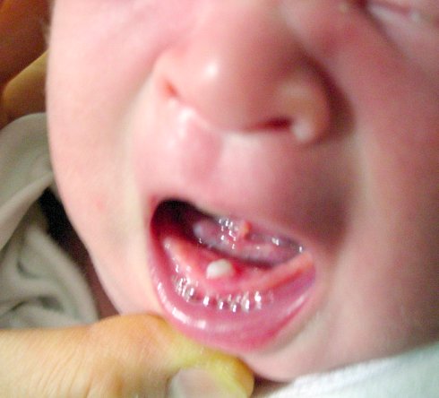 OMG! My newborn baby has teeth!- Dr Nurjasmine Aida Jamani & Dr Nor Asilah  Harun